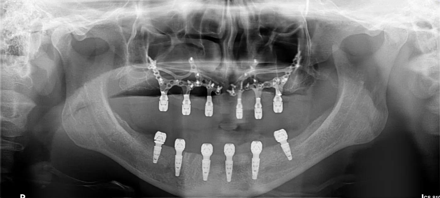 După: radiografie panoramică cu implanturi plasate