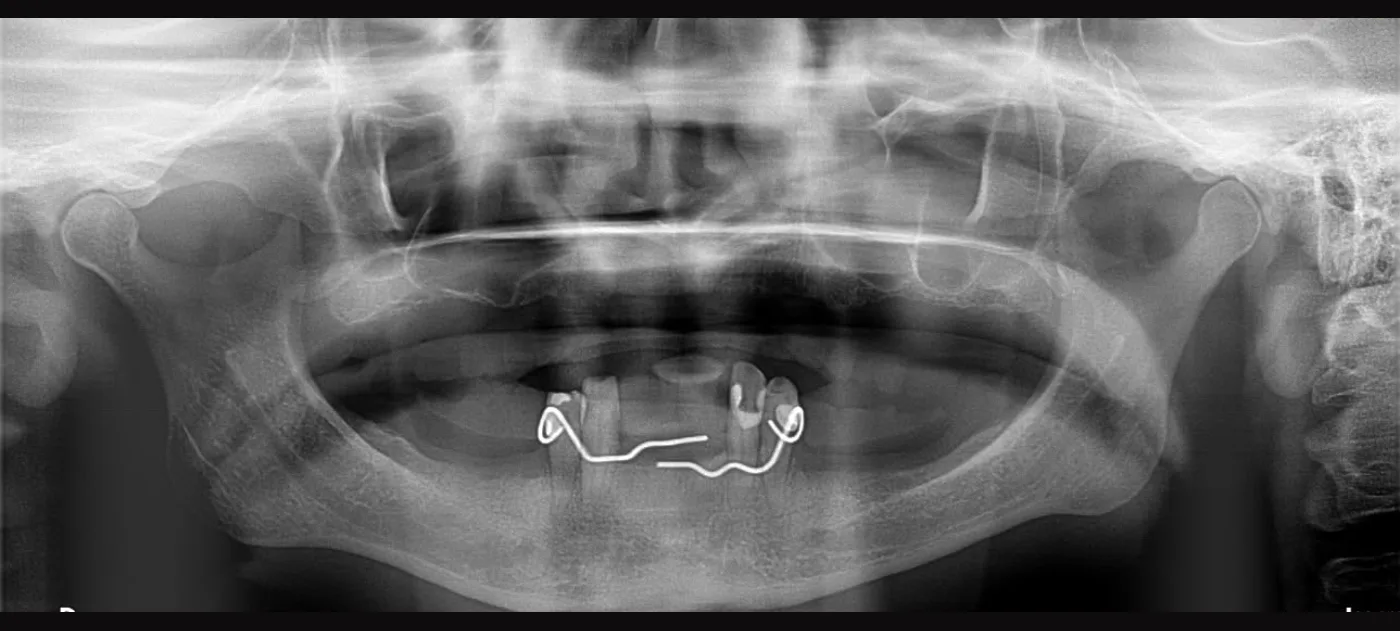 Înainte: radiografie panoramică, arcade parțial edentate
